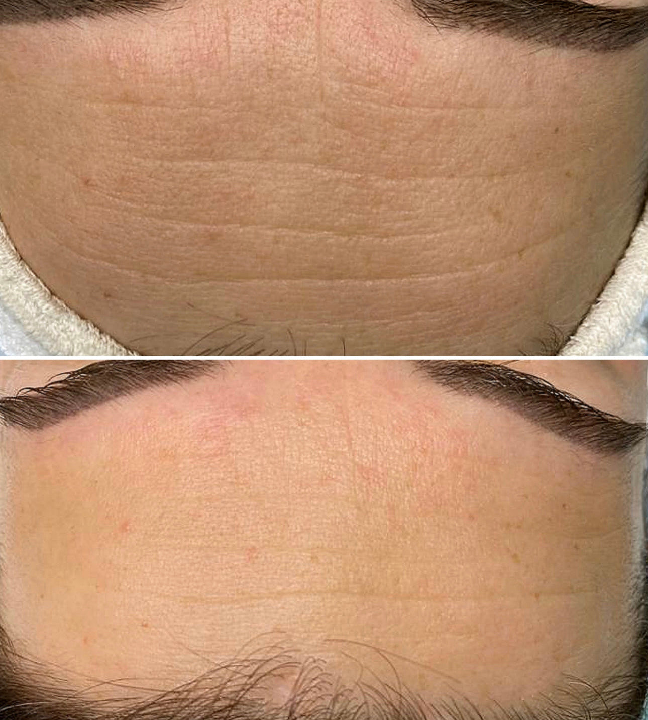 BioSkin BioRepeel TCA Peel (Series of 4) *Service