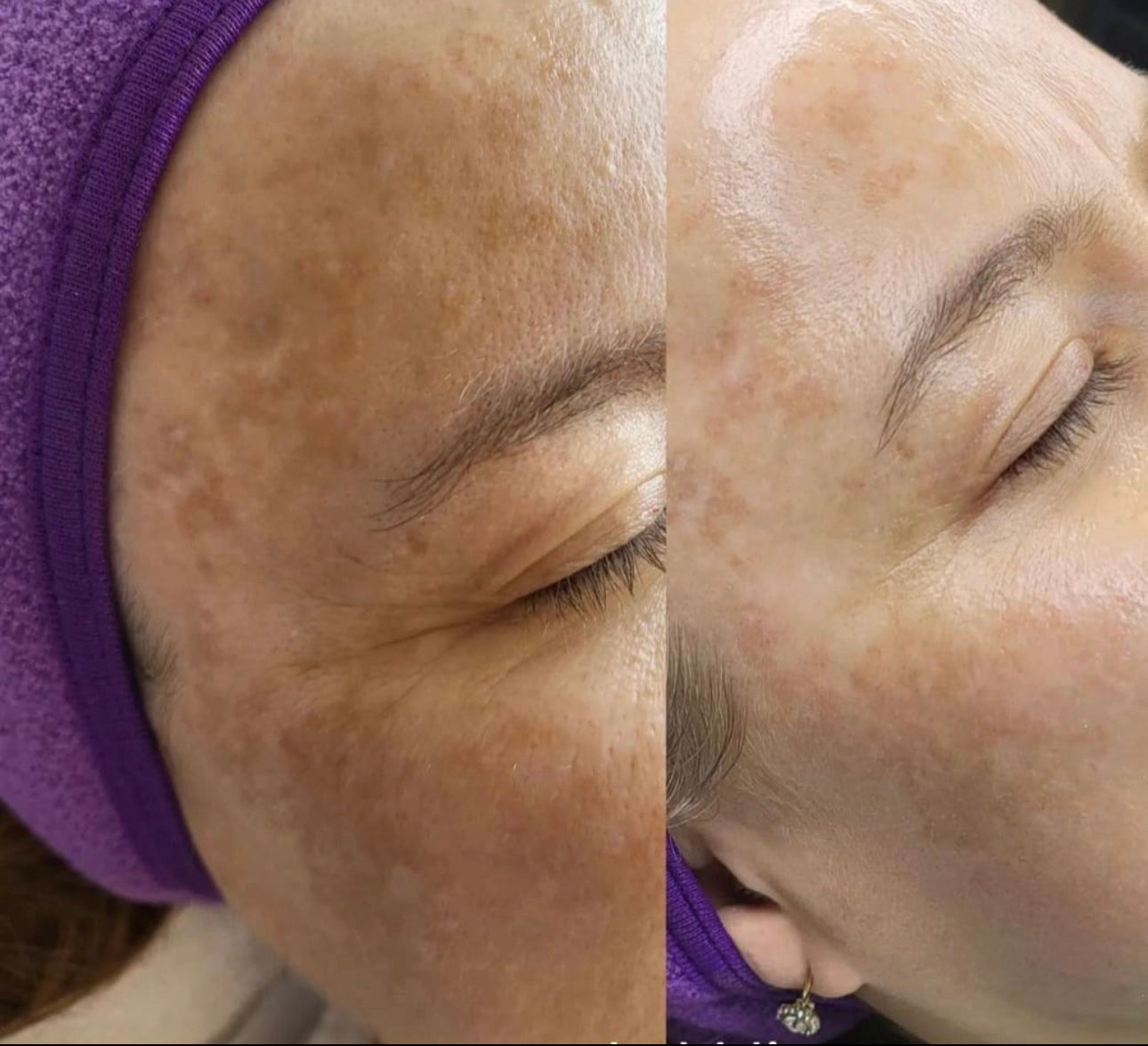 BioSkin BioRepeel TCA Peel (Series of 4) *Service