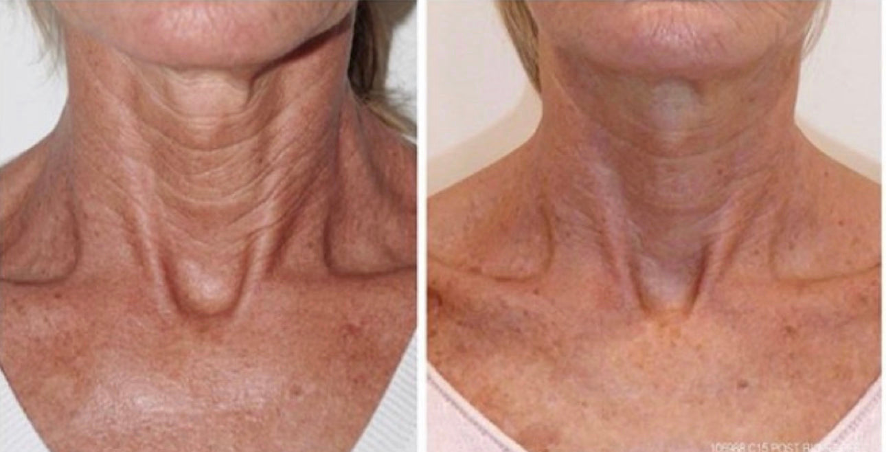 BioSkin BioRepeel TCA Peel (Series of 3) *Service