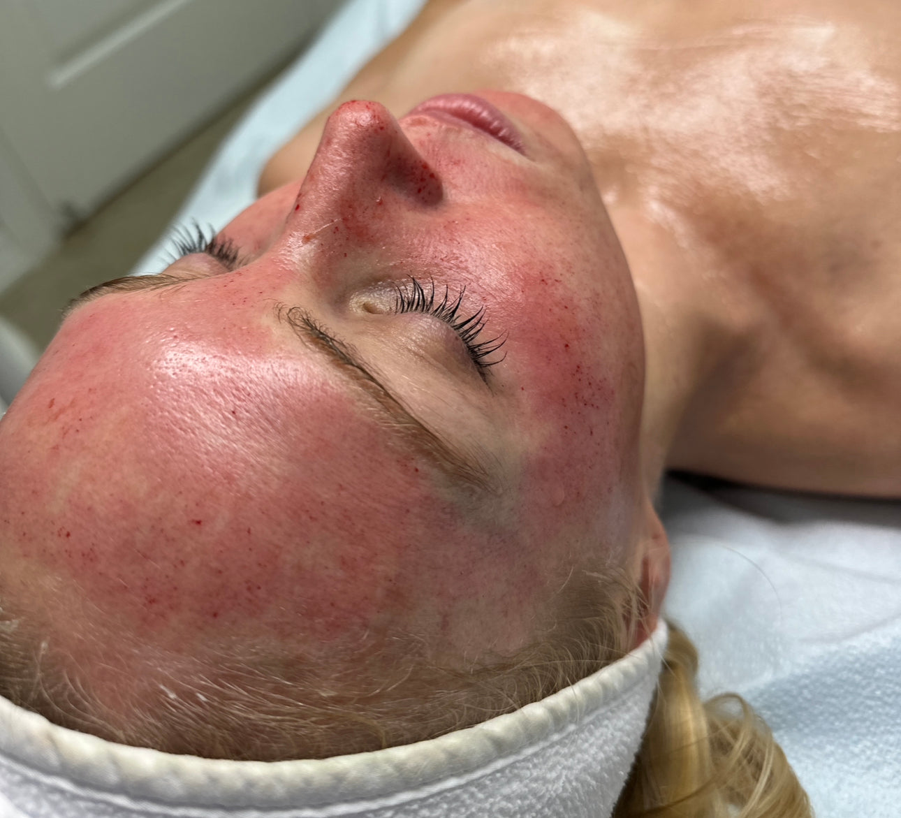 Collagen Induction Therapy: Skinpen Microneedling       (Series of 3) *Service