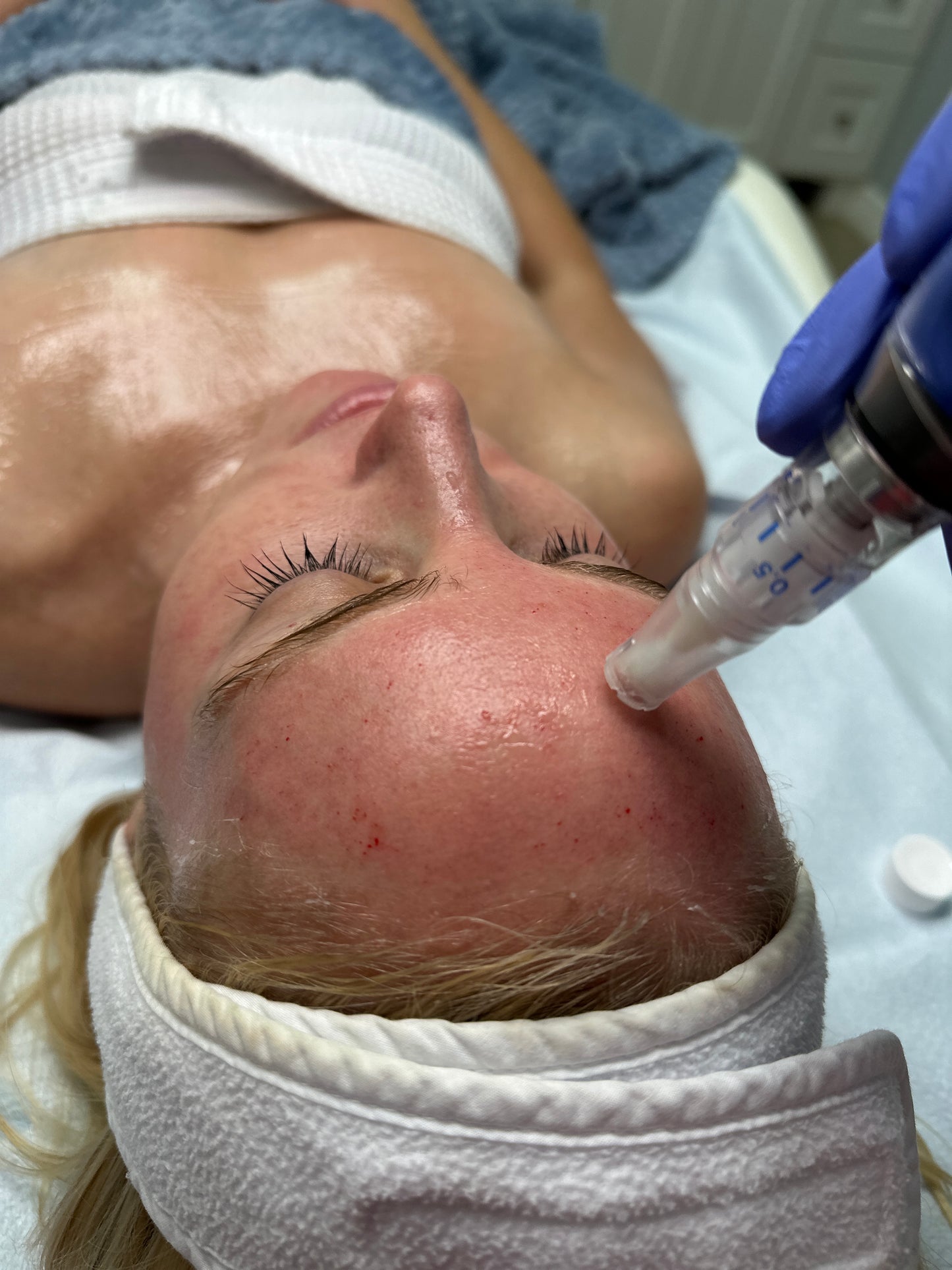 Collagen Induction Therapy: Skinpen Microneedling (Single) *Service