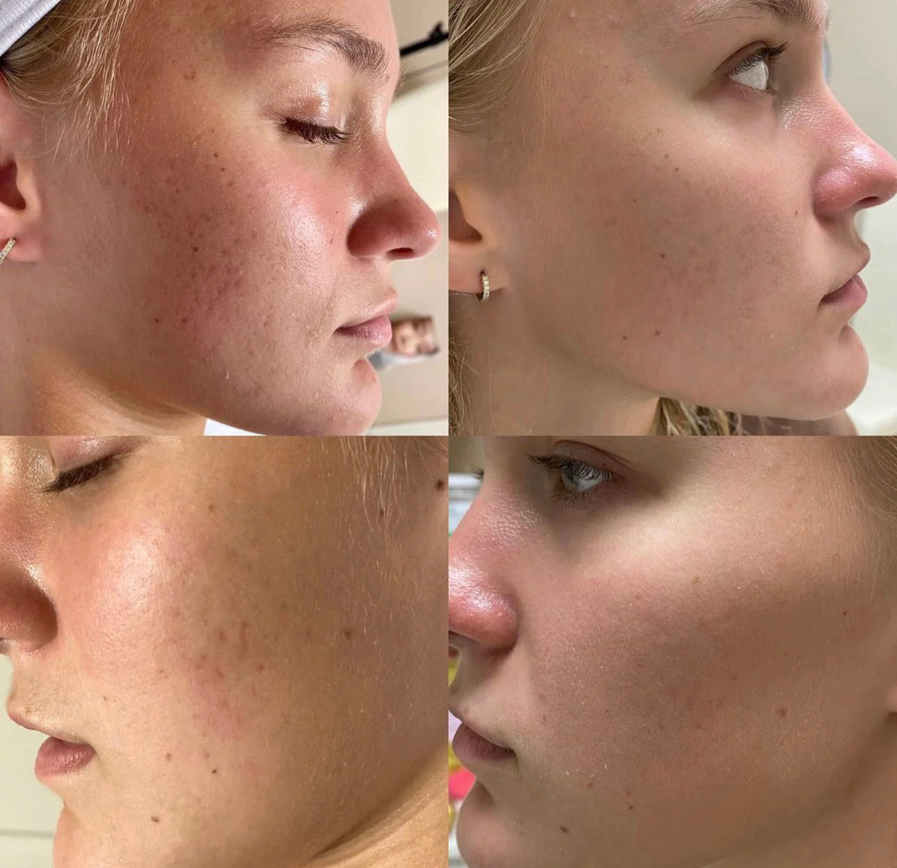 Collagen Induction Therapy: Skinpen Microneedling       (Series of 3) *Service