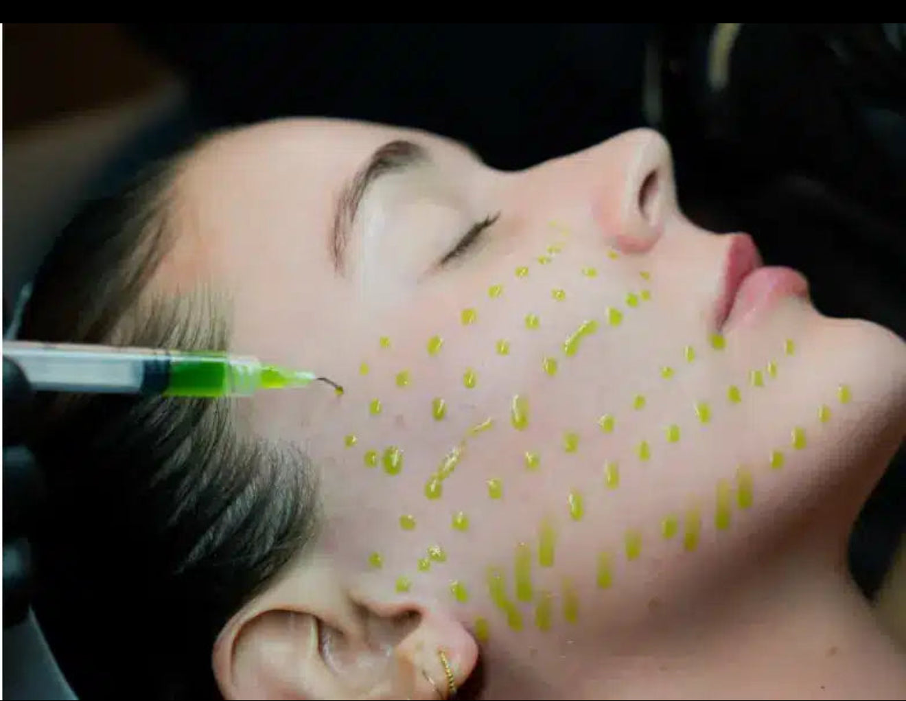 BioSkin BioRepeel TCA Peel (Series of 3) *Service