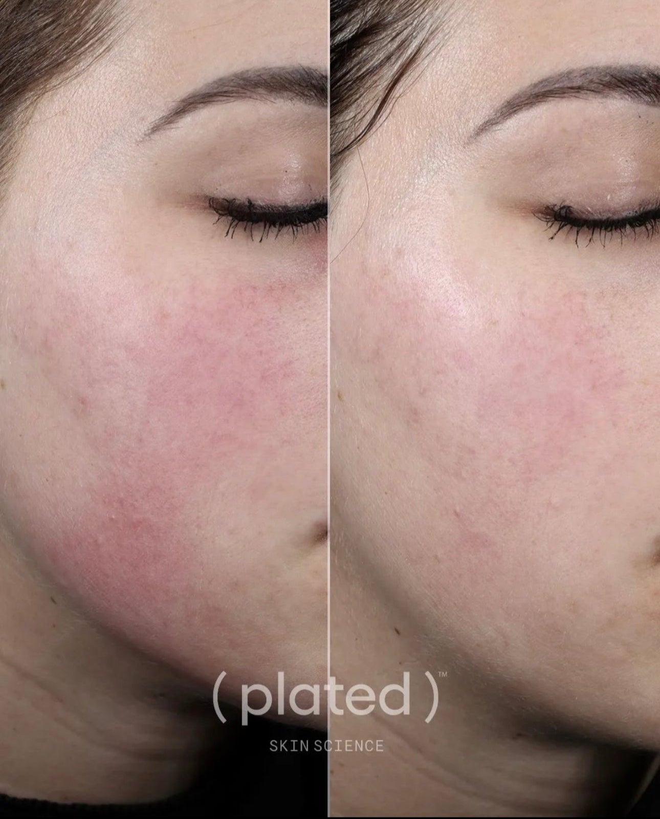 Plated Exosomes Serum: (DAILY)