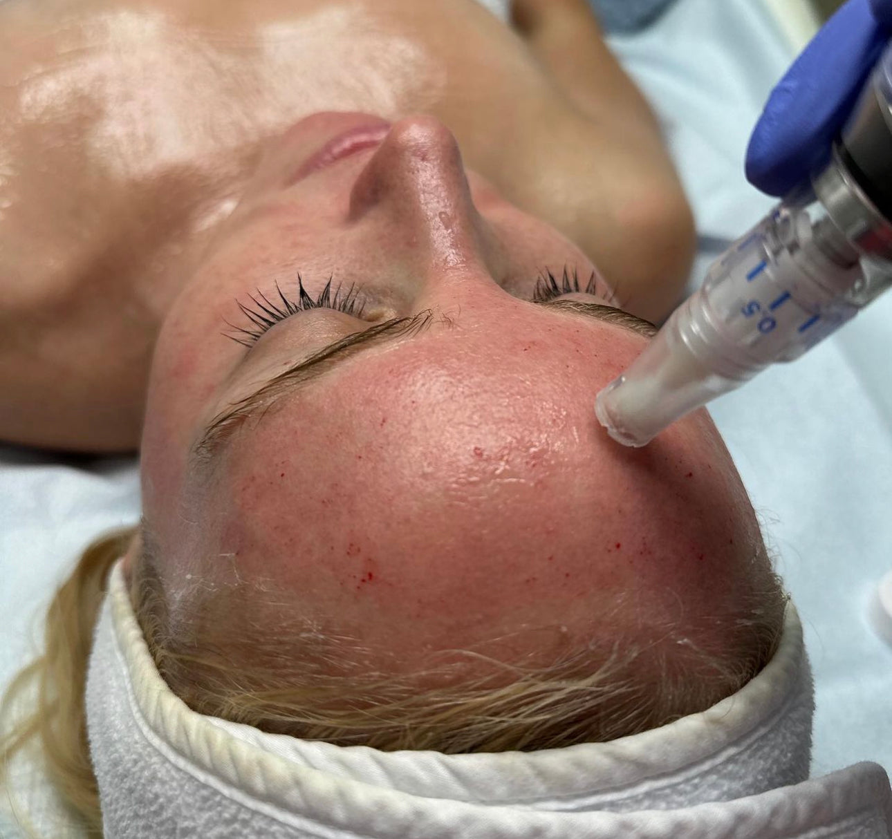 Collagen Induction Therapy: Skinpen Microneedling       (Series of 3) *Service