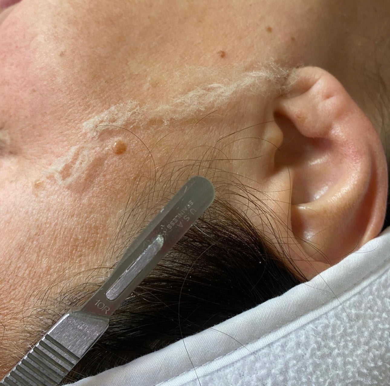 Dermaplaning (Add-on Service) *Service