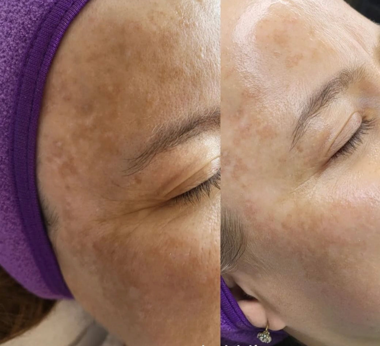 BioSkin BioRepeel TCA Peel (Single) *Service