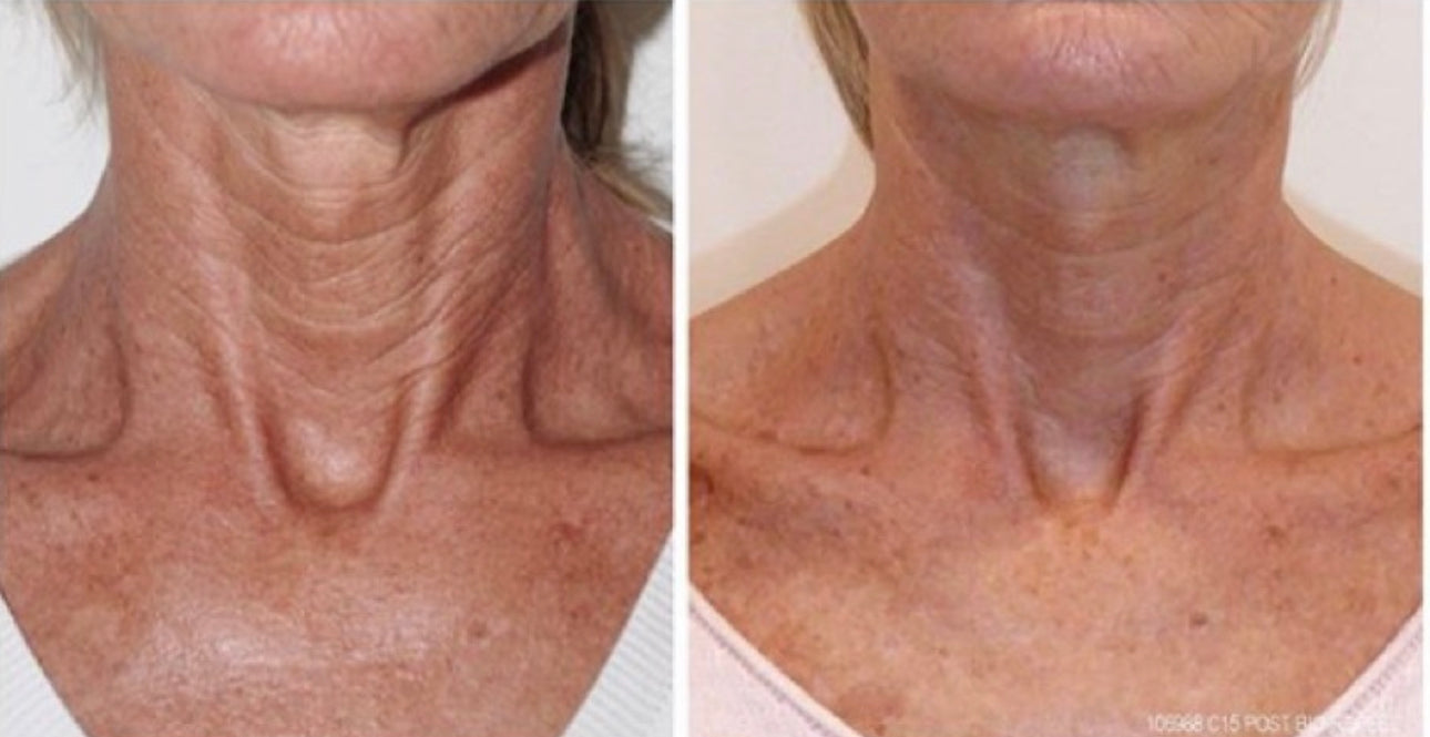 BioSkin BioRepeel TCA Peel (Single) *Service